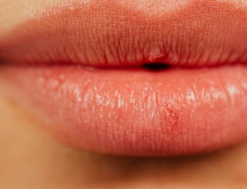 Filler labbra