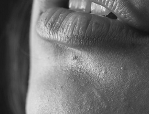 Filler labbra
